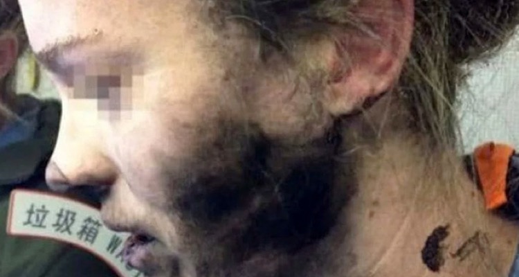Picture of the woman burned by Apple's Beats by Dre headphones